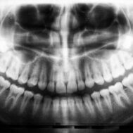 An X-Ray showing tooth decay.