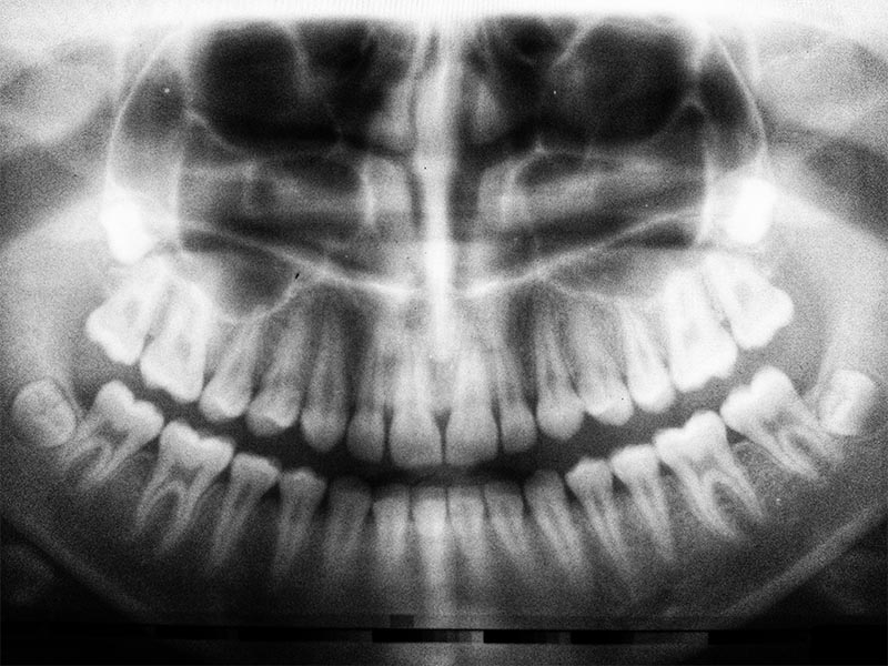 An X-Ray showing tooth decay.