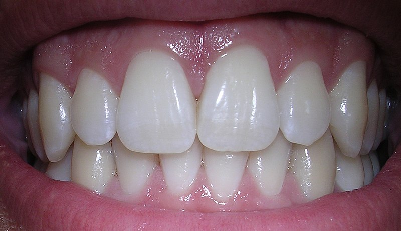 A patients smile that has been looked after by following their aftercare instructions.