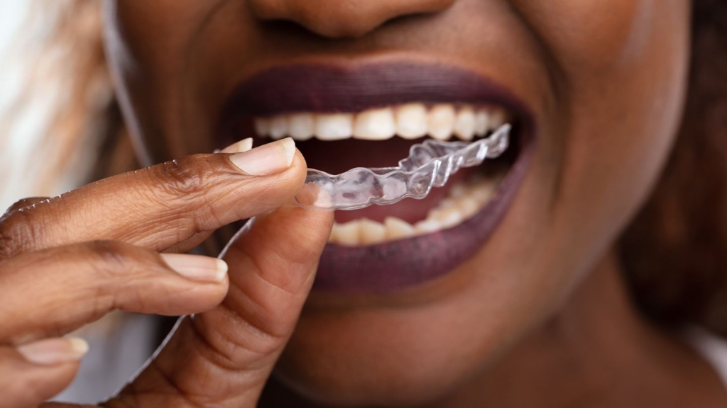 A patient putting in a mouth guard to help prevent teeth grinding.