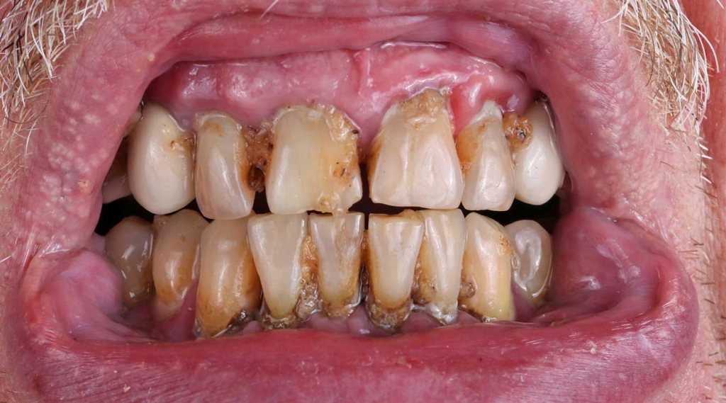 Effects of alcohol on teeth.